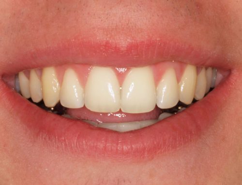 CASO: Ortodoncia lingual, apiñamiento, sobremordida y clase II