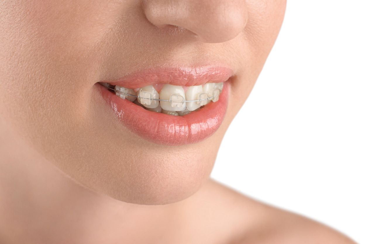 brackets esteticos - tratamientos ortodoncia - Abad y Antolin Ortodoncia